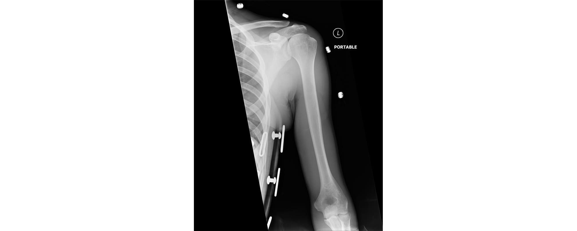 An x-ray of Ian Kinney's shoulder.